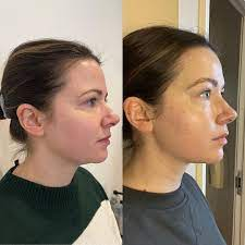 DrenaFace - Escova de Drenagem Linfática Facial - Escova Coreana